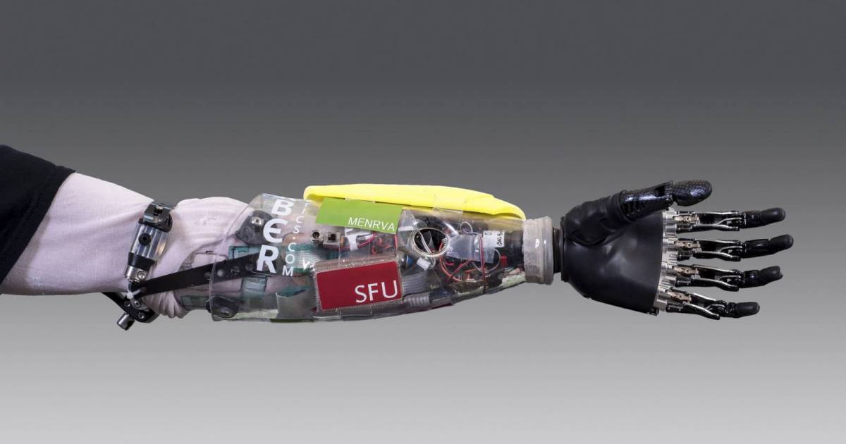 SFU researchers build paraathlete a "bionic hand" for world's first